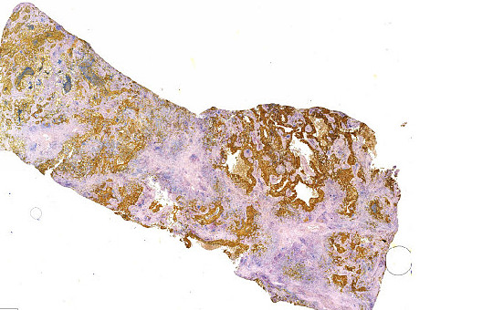 Lung Adenocarcinoma: PD-L1, CD8, PanCK. Entire image.